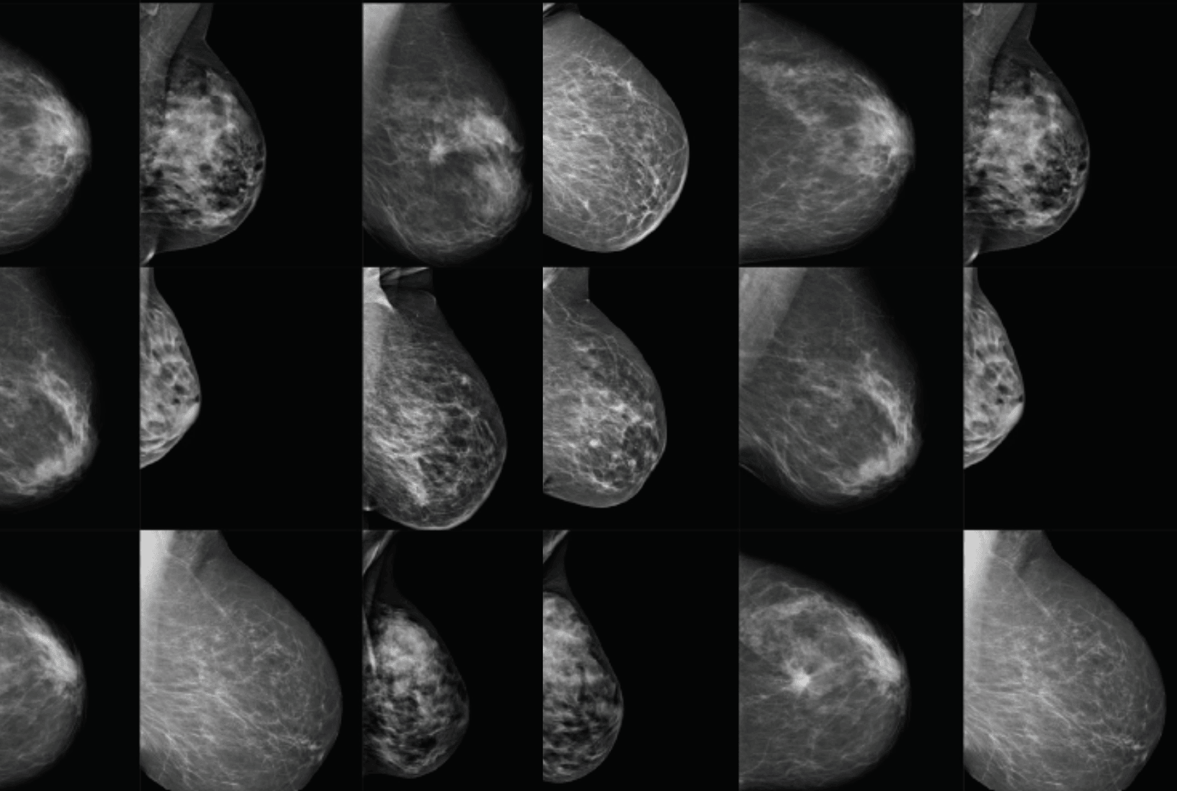 MECCA backs BRAIx to bring AI-powered breast cancer detection into screening programs across Australia